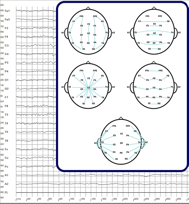 hospital-EEG-